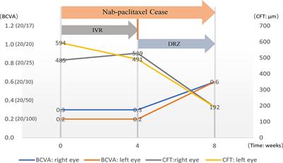 Intravitreal Ranibizumab Had Limited Effect on Cystoid Macular Edema Due to Albumin-Bound Paclitaxel: A Case Report and Literature Review